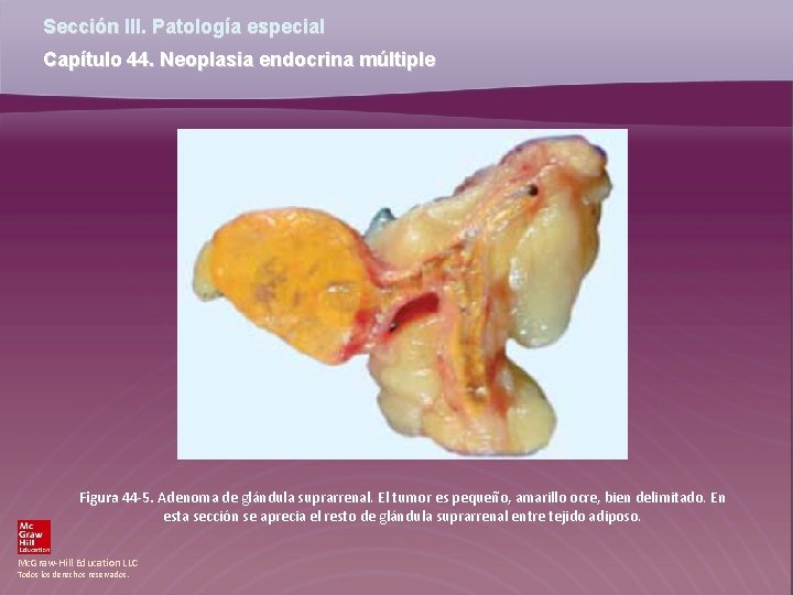 Sección III. Patología especial Capítulo 44. Neoplasia endocrina múltiple Figura 44 -5. Adenoma de