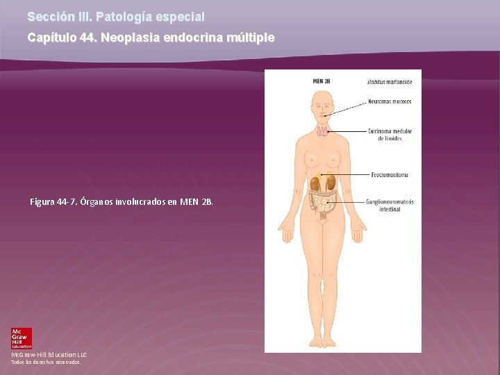 Sección III. Patología especial Capítulo 44. Neoplasia endocrina múltiple Figura 44 -7. Órganos involucrados