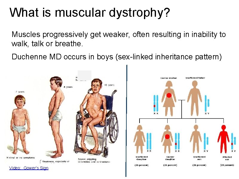 What is muscular dystrophy? Muscles progressively get weaker, often resulting in inability to walk,