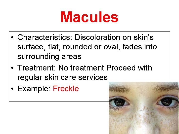 Macules • Characteristics: Discoloration on skin’s surface, flat, rounded or oval, fades into surrounding