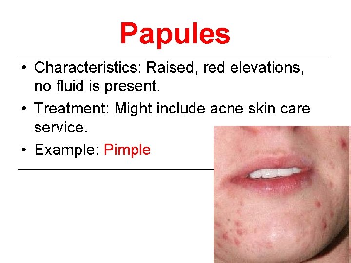 Papules • Characteristics: Raised, red elevations, no fluid is present. • Treatment: Might include