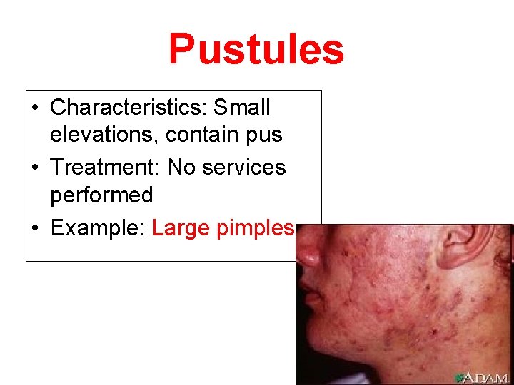 Pustules • Characteristics: Small elevations, contain pus • Treatment: No services performed • Example: