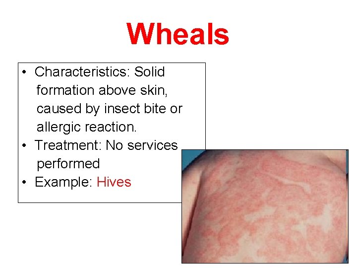 Wheals • Characteristics: Solid formation above skin, caused by insect bite or allergic reaction.