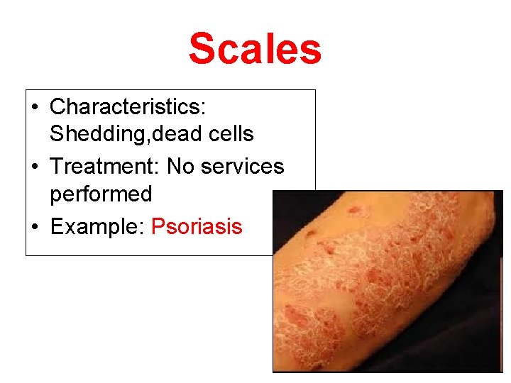 Scales • Characteristics: Shedding, dead cells • Treatment: No services performed • Example: Psoriasis