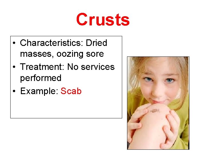 Crusts • Characteristics: Dried masses, oozing sore • Treatment: No services performed • Example: