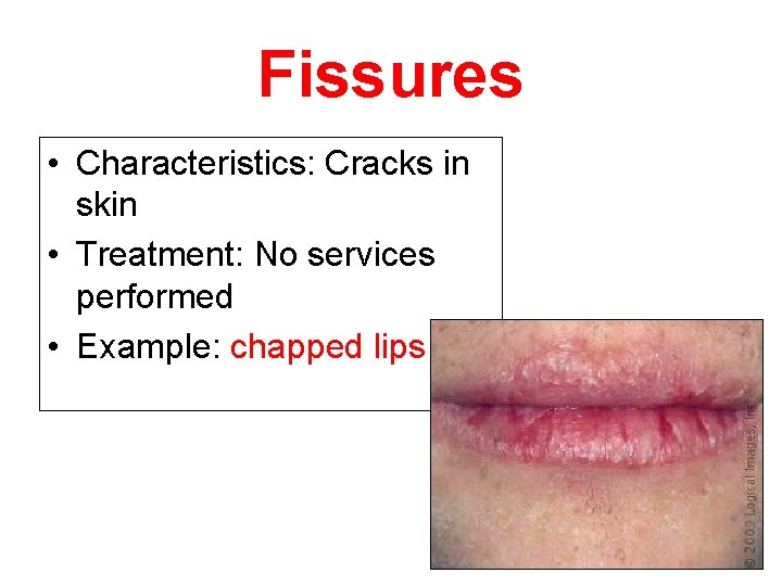 Fissures • Characteristics: Cracks in skin • Treatment: No services performed • Example: chapped