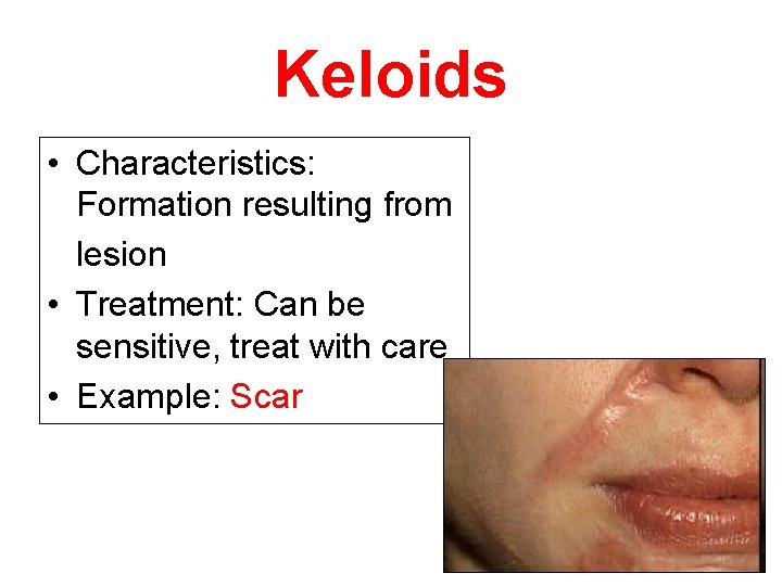Keloids • Characteristics: Formation resulting from lesion • Treatment: Can be sensitive, treat with