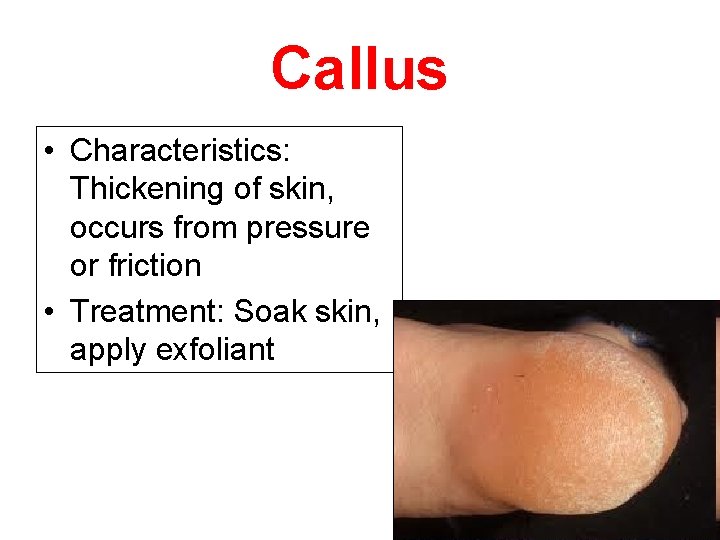 Callus • Characteristics: Thickening of skin, occurs from pressure or friction • Treatment: Soak
