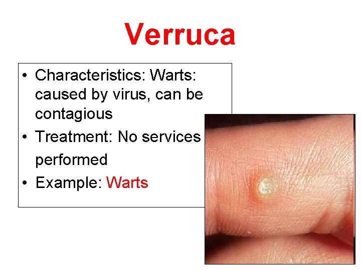 Verruca • Characteristics: Warts: caused by virus, can be contagious • Treatment: No services