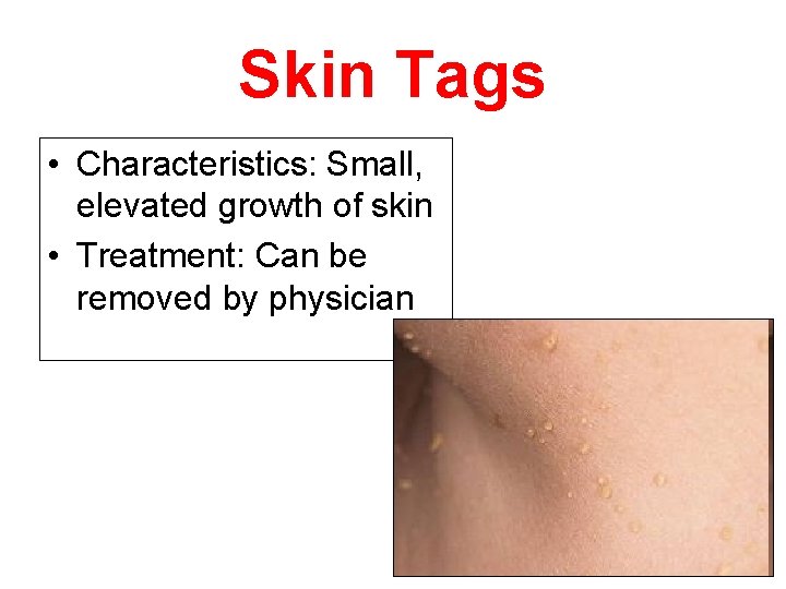 Skin Tags • Characteristics: Small, elevated growth of skin • Treatment: Can be removed