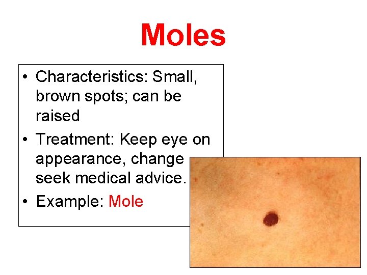 Moles • Characteristics: Small, brown spots; can be raised • Treatment: Keep eye on