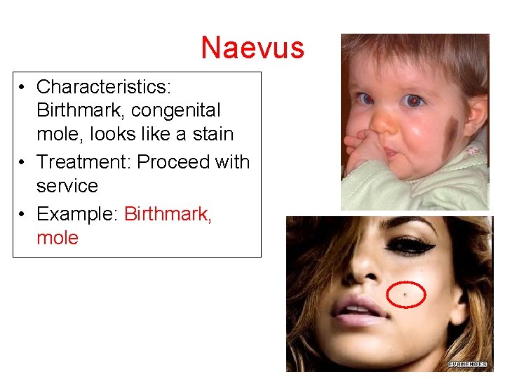 Naevus • Characteristics: Birthmark, congenital mole, looks like a stain • Treatment: Proceed with