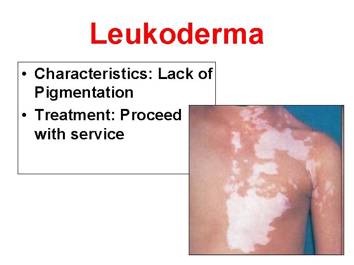 Leukoderma • Characteristics: Lack of Pigmentation • Treatment: Proceed with service 