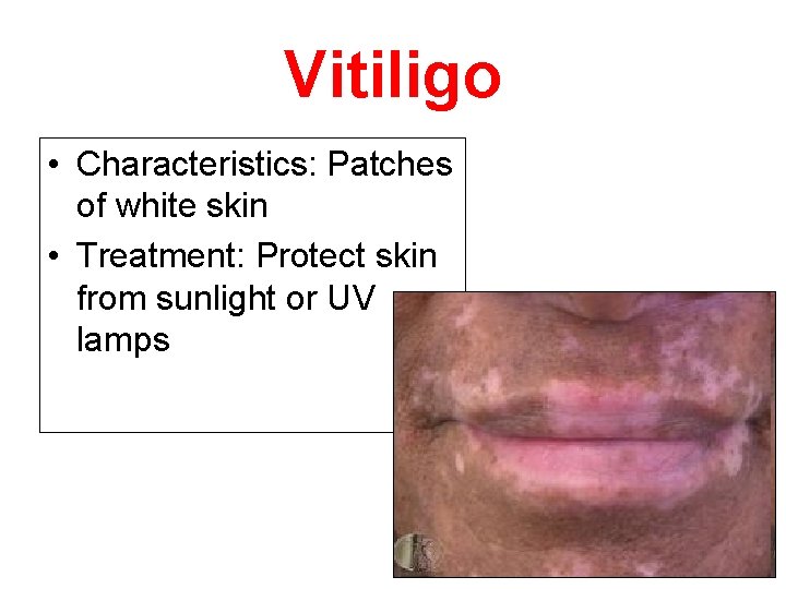 Vitiligo • Characteristics: Patches of white skin • Treatment: Protect skin from sunlight or