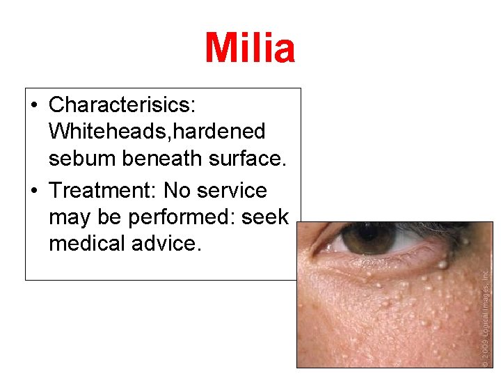 Milia • Characterisics: Whiteheads, hardened sebum beneath surface. • Treatment: No service may be