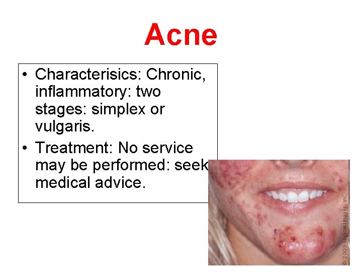 Acne • Characterisics: Chronic, inflammatory: two stages: simplex or vulgaris. • Treatment: No service