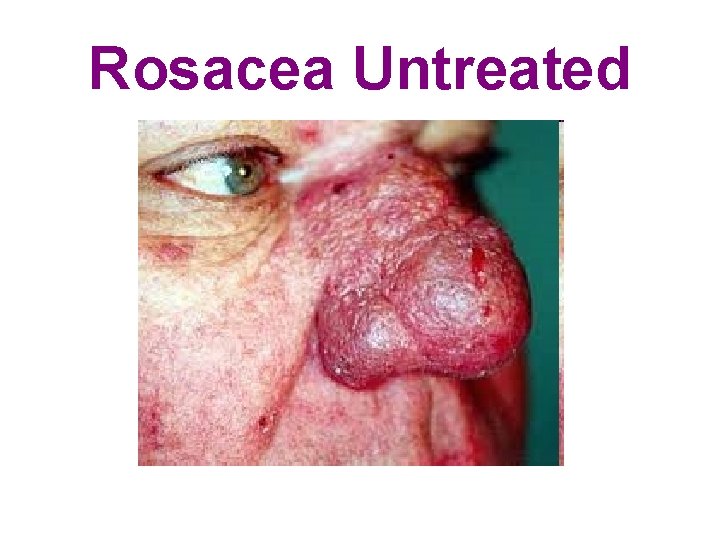 Rosacea Untreated 