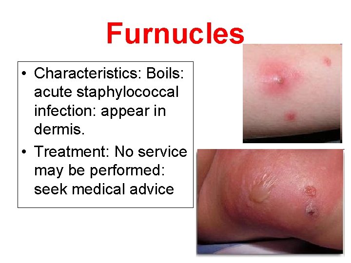 Furnucles • Characteristics: Boils: acute staphylococcal infection: appear in dermis. • Treatment: No service