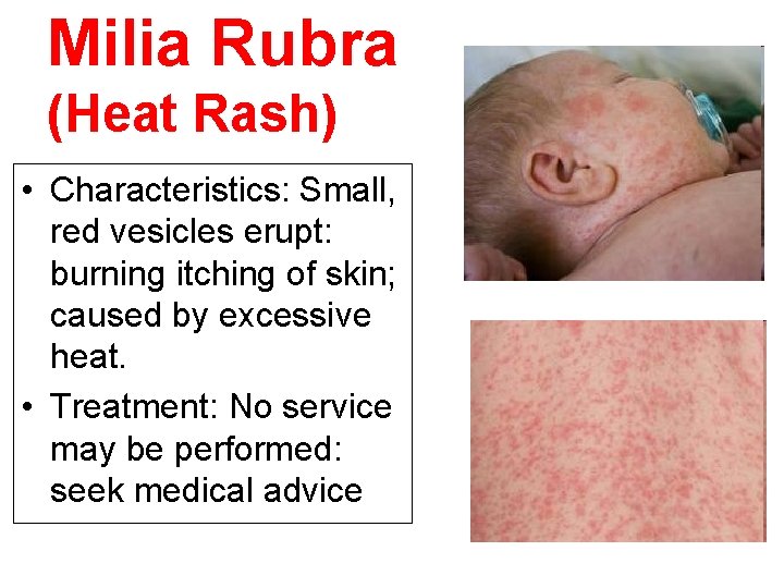 Milia Rubra (Heat Rash) • Characteristics: Small, red vesicles erupt: burning itching of skin;