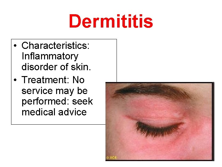 Dermititis • Characteristics: Inflammatory disorder of skin. • Treatment: No service may be performed: