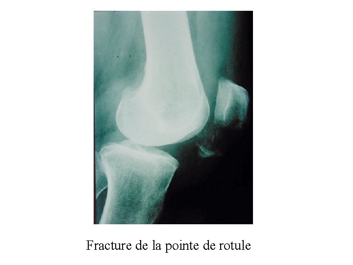 Fracture de la pointe de rotule 