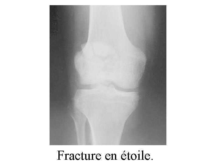 Fracture en étoile. 