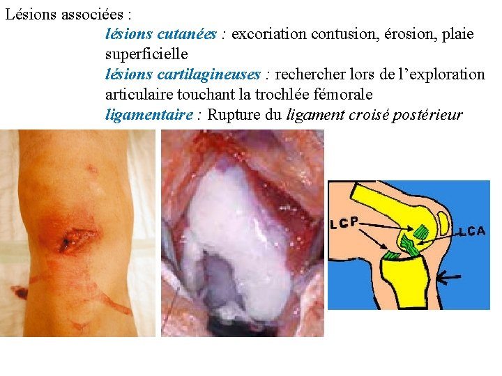 Lésions associées : lésions cutanées : excoriation contusion, érosion, plaie superficielle lésions cartilagineuses :