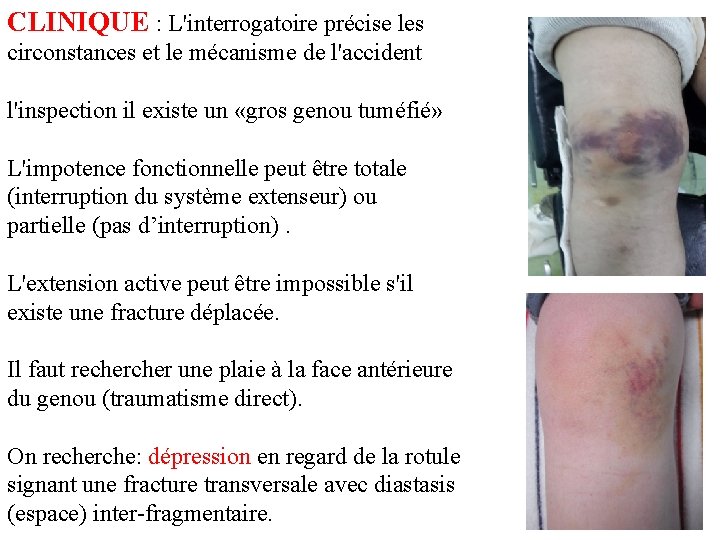 CLINIQUE : L'interrogatoire précise les circonstances et le mécanisme de l'accident l'inspection il existe