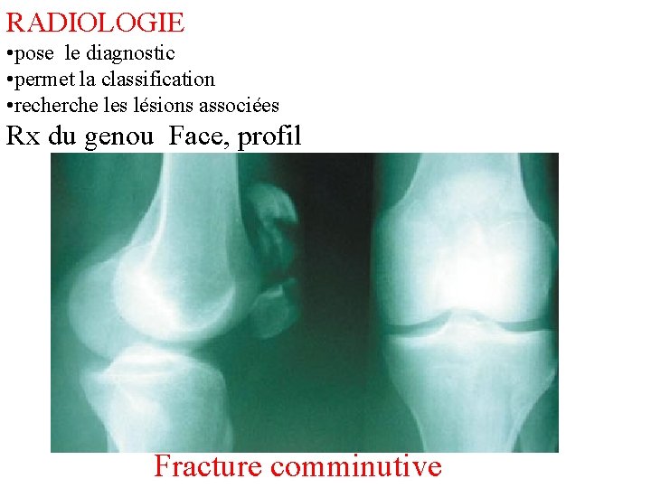 RADIOLOGIE • pose le diagnostic • permet la classification • recherche les lésions associées