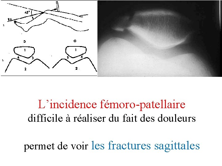 L’incidence fémoro-patellaire difficile à réaliser du fait des douleurs permet de voir les fractures