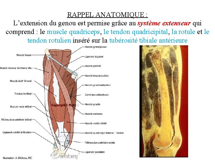 RAPPEL ANATOMIQUE : L’extension du genou est permise grâce au système extenseur qui comprend