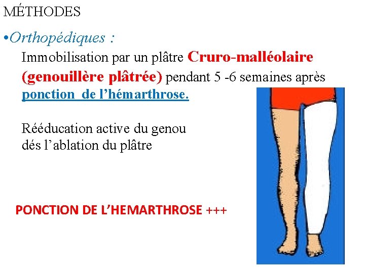 MÉTHODES • Orthopédiques : Immobilisation par un plâtre Cruro-malléolaire (genouillère plâtrée) pendant 5 -6