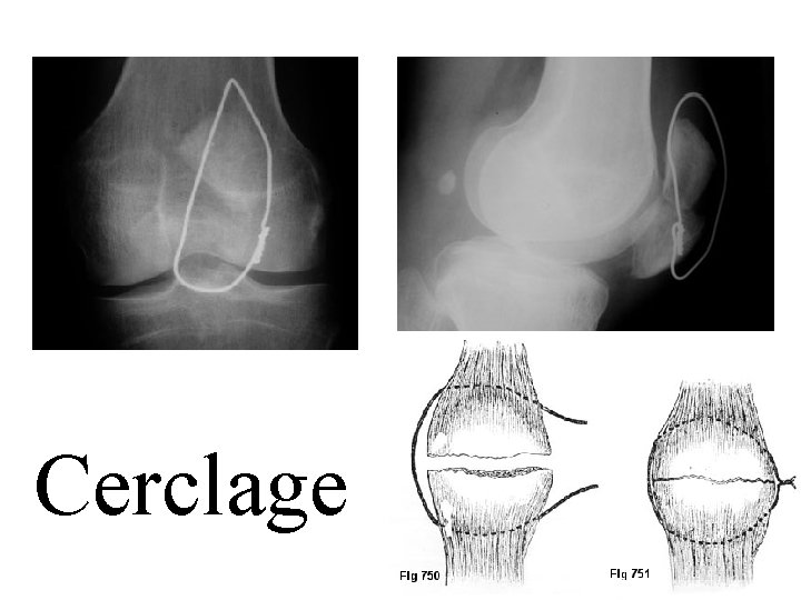 Cerclage 