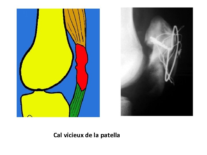 Cal vicieux de la patella 