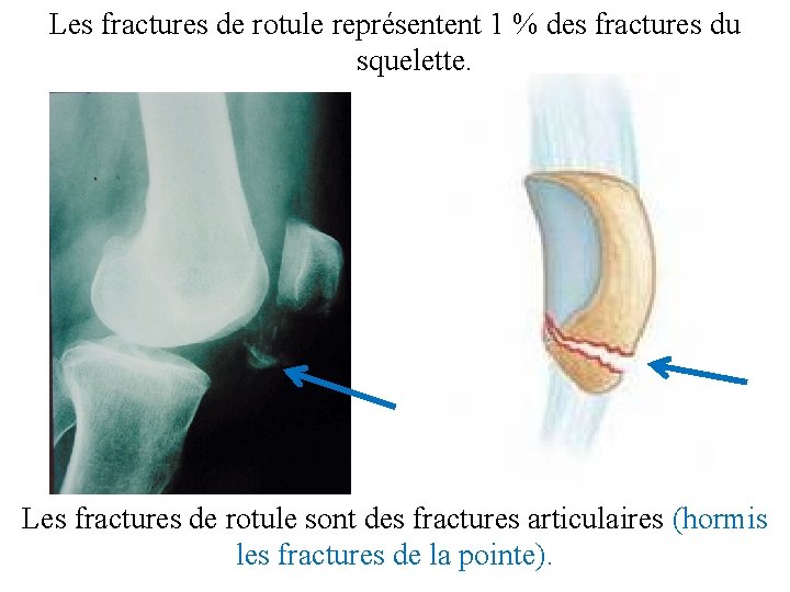 Les fractures de rotule représentent 1 % des fractures du squelette. Les fractures de