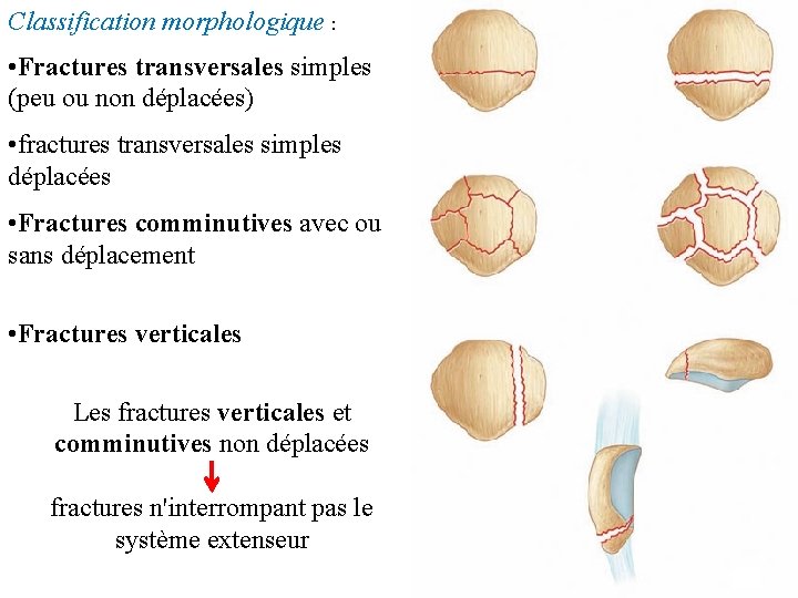 Classification morphologique : • Fractures transversales simples (peu ou non déplacées) • fractures transversales