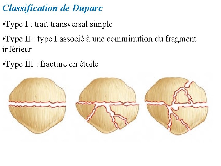 Classification de Duparc • Type I : trait transversal simple • Type II :