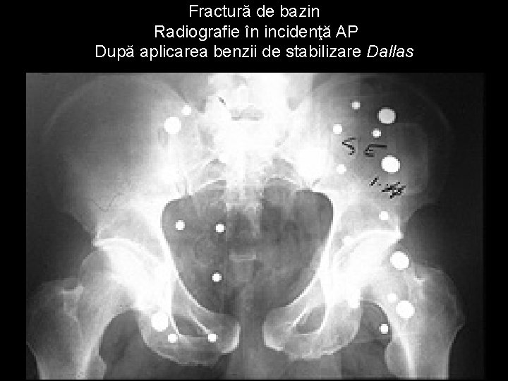 Fractură de bazin Radiografie în incidenţă AP După aplicarea benzii de stabilizare Dallas 