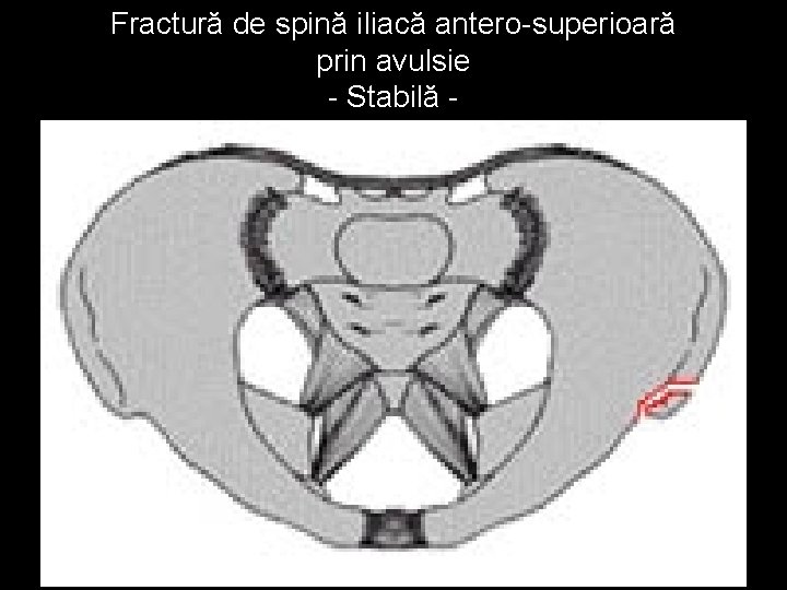 Fractură de spină iliacă antero-superioară prin avulsie - Stabilă - 