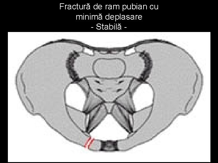 Fractură de ram pubian cu minimă deplasare - Stabilă - 