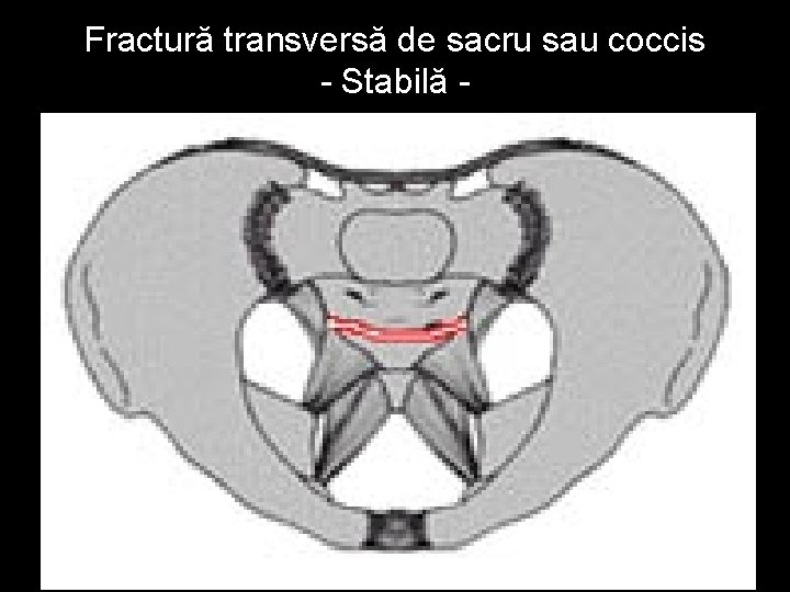 Fractură transversă de sacru sau coccis - Stabilă - 