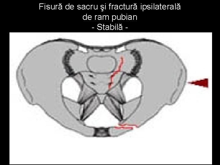 Fisură de sacru şi fractură ipsilaterală de ram pubian - Stabilă - 