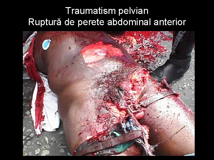 Traumatism pelvian Ruptură de perete abdominal anterior 