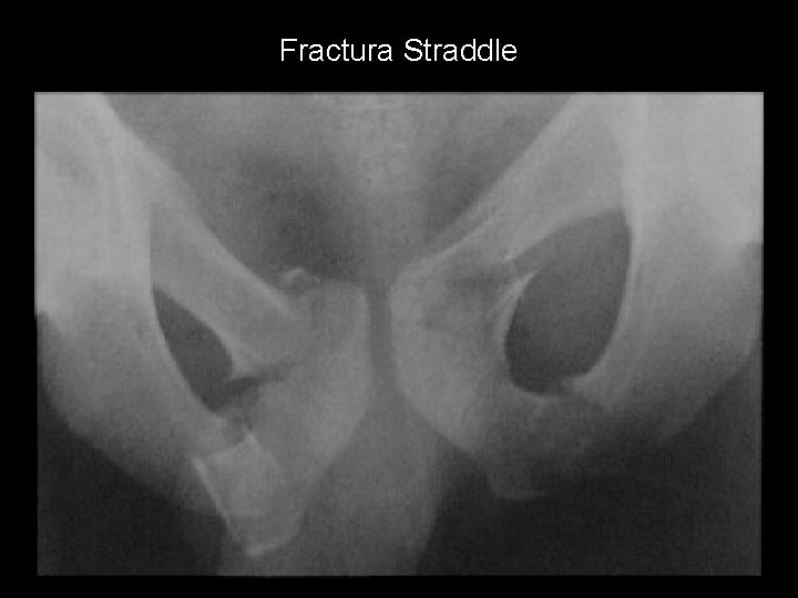 Fractura Straddle 