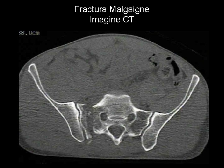 Fractura Malgaigne Imagine CT 