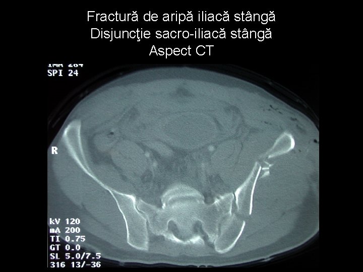 Fractură de aripă iliacă stângă Disjuncţie sacro-iliacă stângă Aspect CT 