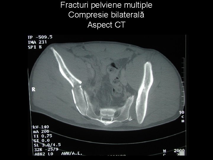 Fracturi pelviene multiple Compresie bilaterală Aspect CT 