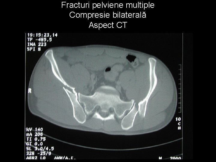 Fracturi pelviene multiple Compresie bilaterală Aspect CT 