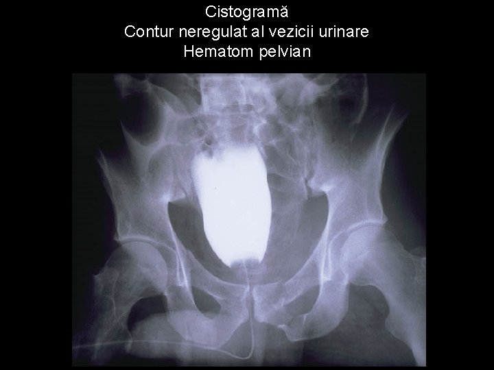 Cistogramă Contur neregulat al vezicii urinare Hematom pelvian 