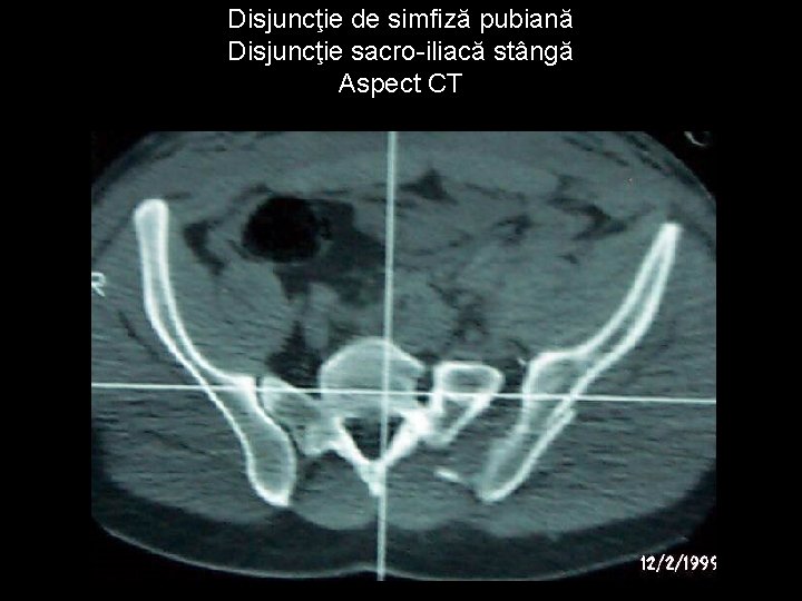 Disjuncţie de simfiză pubiană Disjuncţie sacro-iliacă stângă Aspect CT 